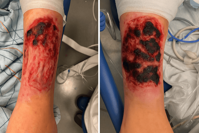 Side-by-side hospital photos of severe necrotic skin ulcers on the lower leg with black eschar and surrounding inflammation, consistent with xylazine-adulterated fentanyl (“tranq”) wounds seen in the current opioid overdose crisis.