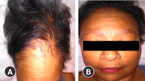 Thallium poisoning symptoms: Significant hair loss (alopecia), receding hairline, and eyebrow thinning in a patient. Thallium toxicity can cause neurological damage, skin abnormalities, and systemic health issues. Early detection and treatment are critical for managing toxicity.