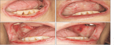 Close-up images showing severe oral mucositis, with inflammation, ulceration, and redness of the oral mucosa, typically seen as a side effect of chemotherapy treatments such as methotrexate. The images highlight the painful sores and lesions affecting the inner lips, tongue, and gums.