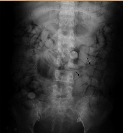 Abdominal X-ray showing suspected drug packets in the intestines, commonly seen in body packers or body stuffers involved in concealed drug trafficking